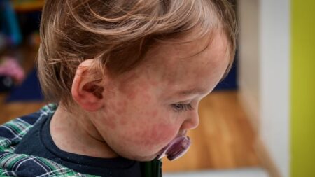 Doctor, virologist caution against attending large public gatherings if unvaccinated against measles