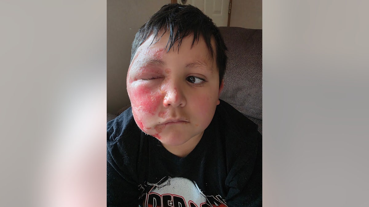 Caleb Chabolla burned face from NeeDoh