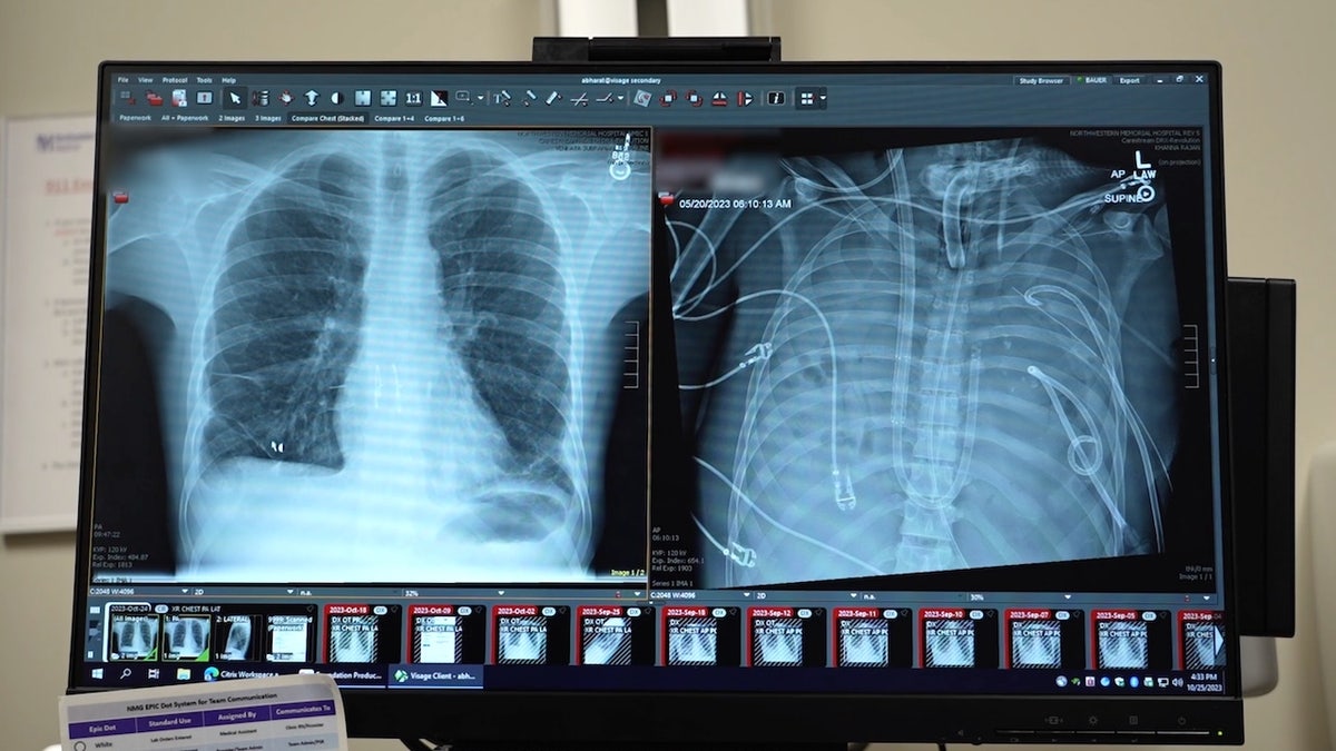 Lung X-ray scans - transplanted lungs