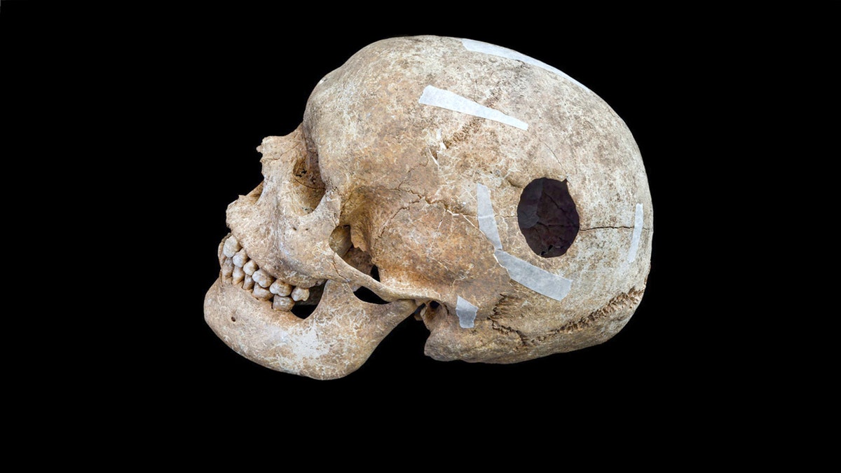 The skull with a hole in it at the Iron Age hillfort in Wandlebury.