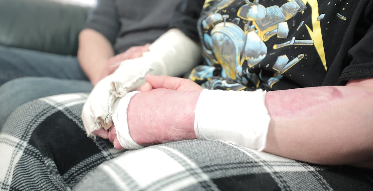 A close-up of a person's arms. They are partially wrapped in gauze and the skin that is showing is scarred by burns.