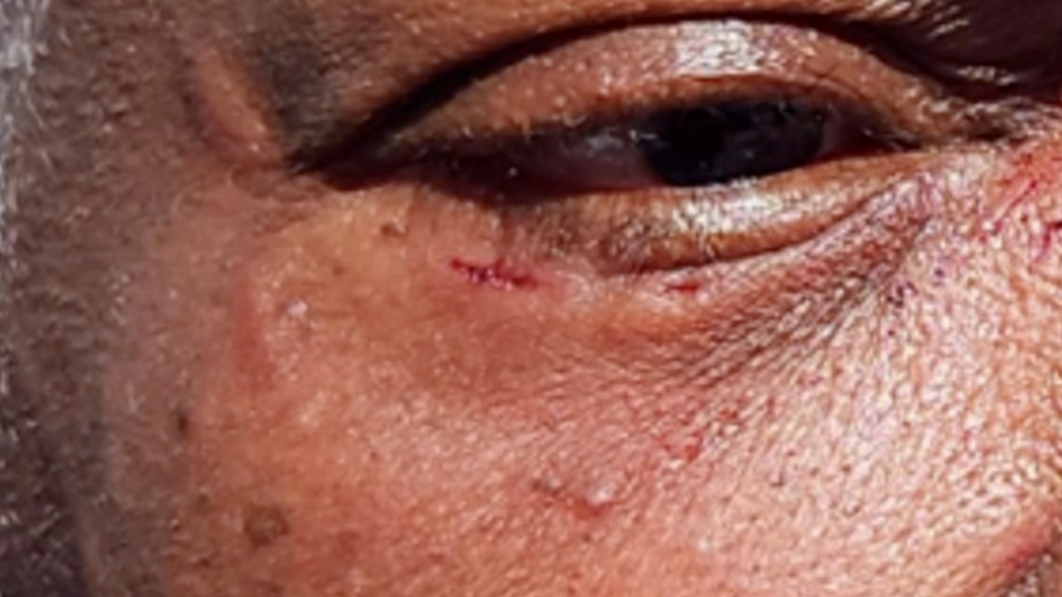 Cut on woman's face