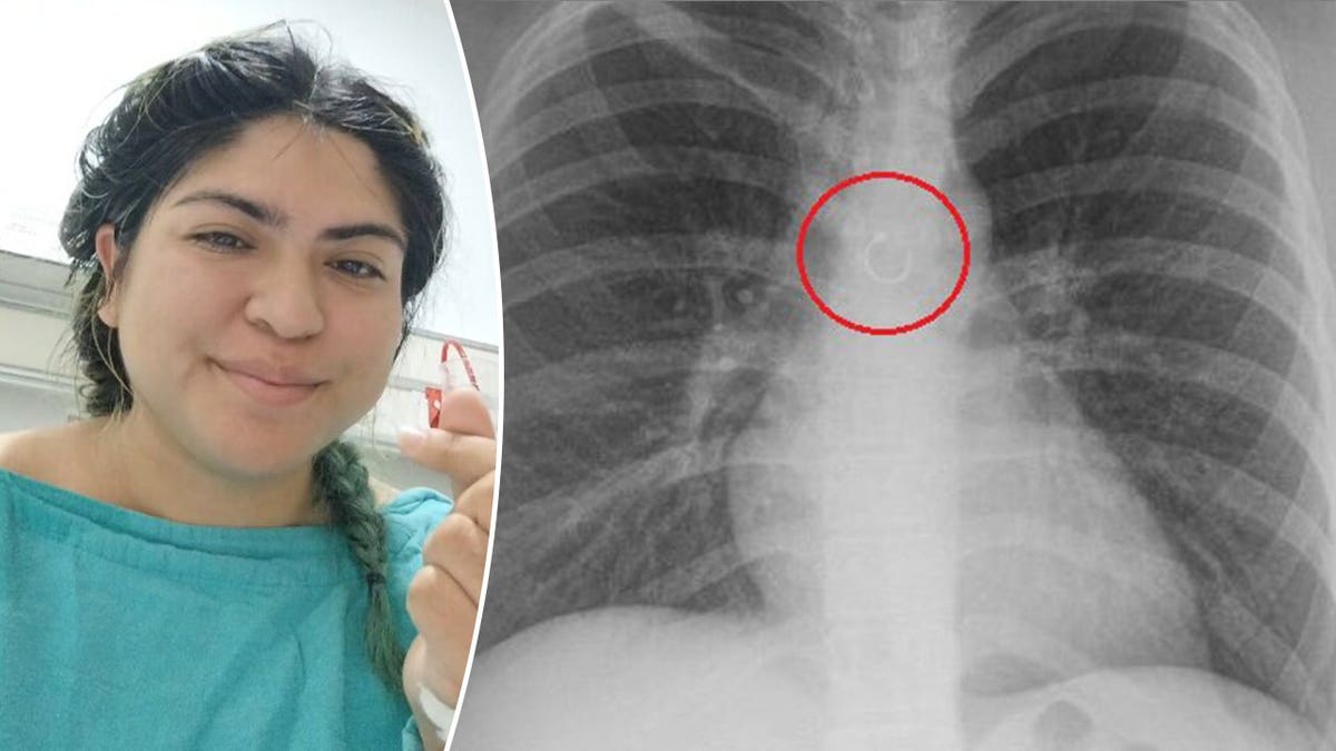 Side by side of Deyanira and her X-ray.