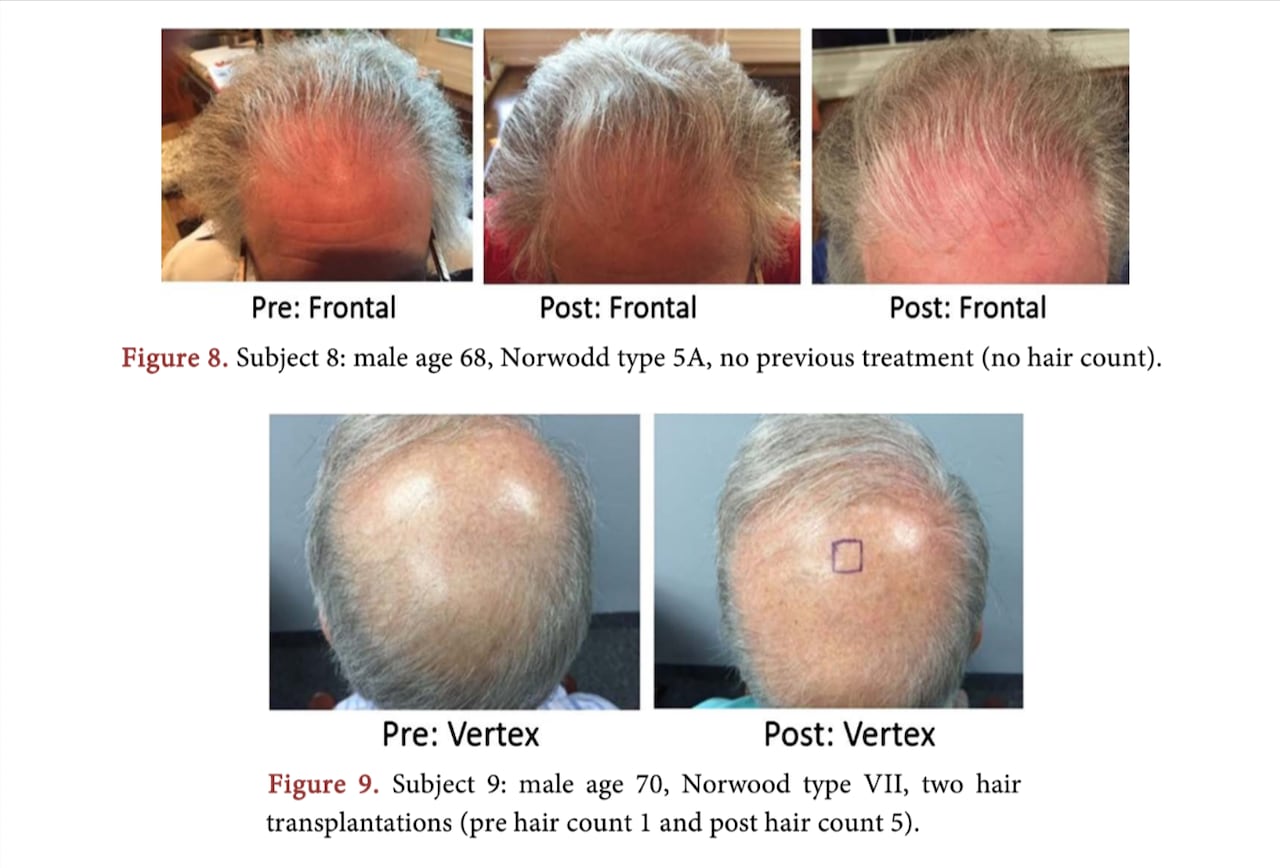 A 2019 study by Yasuhiro Tsukamoto and his Ostrigen colleagues on the use of ostrich antibodies to regrow hair