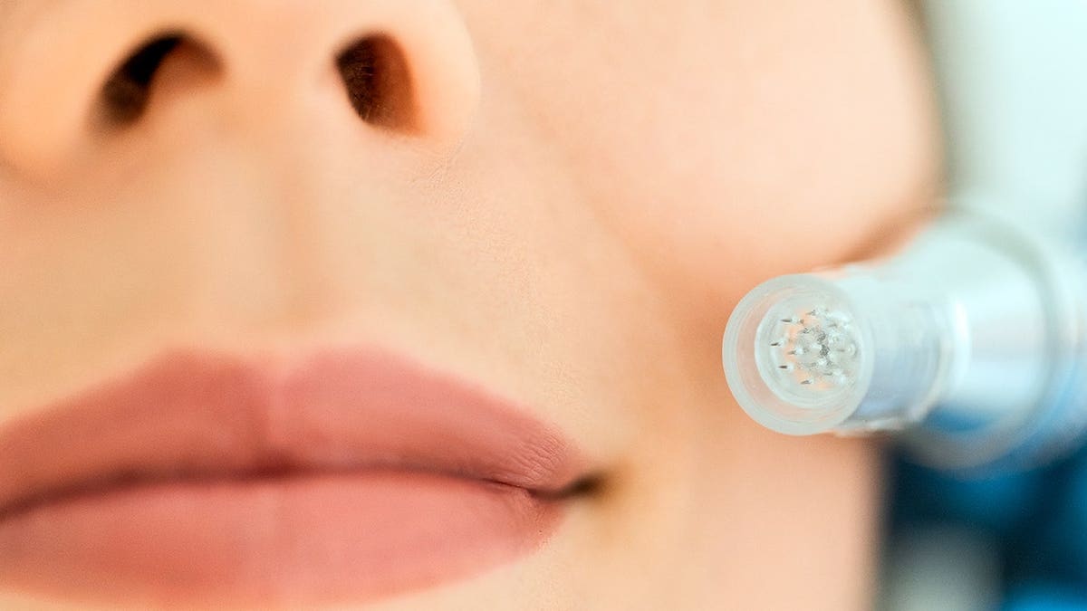 microneedling device held above skin