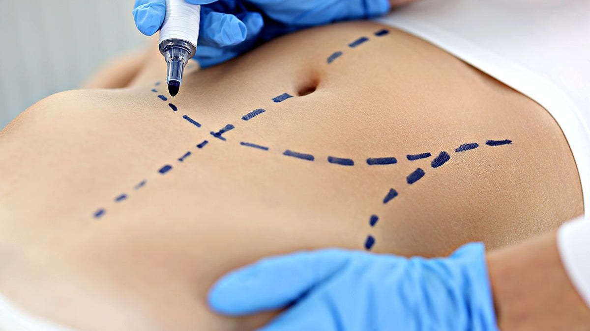 Doctor plastic surgeon drawing preoperative markings on patient's abdomen skin closeup