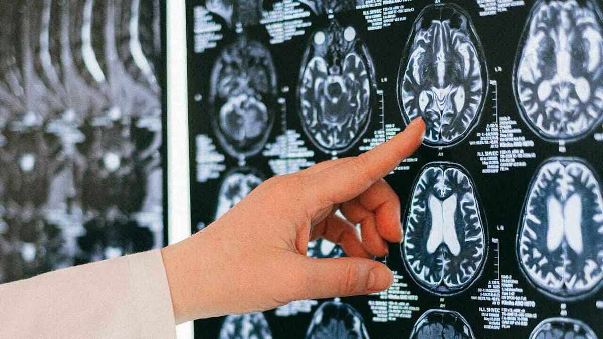 Doctor's hand pointing at a brain scan image on a screen