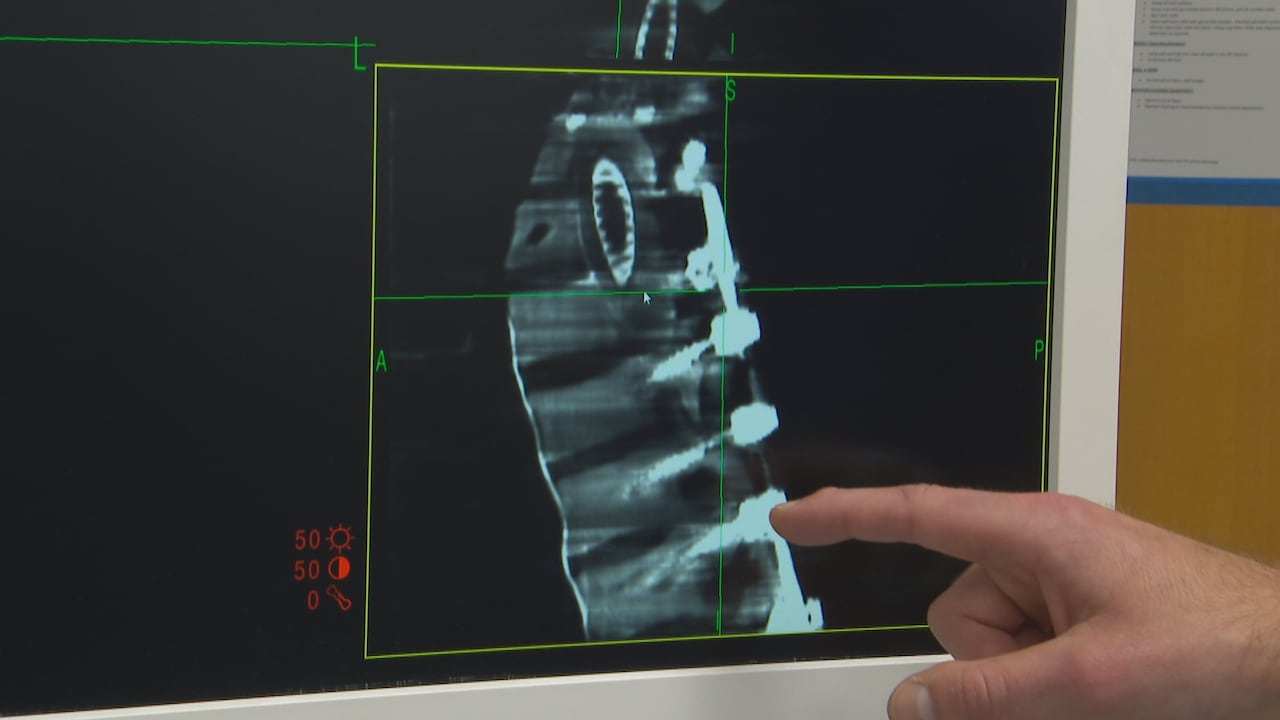 A hand indicated screws on a 3D image of a fake spine on a computer screen.