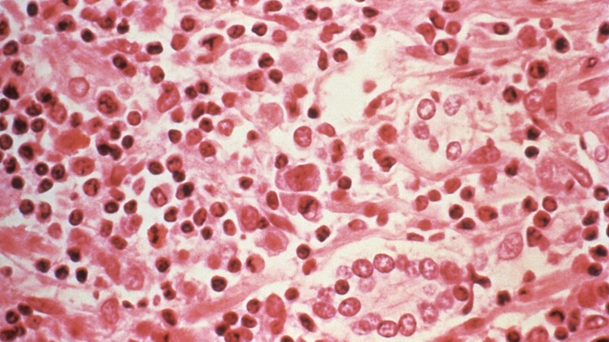 A micrographic study of liver tissue seen from a Hantavirus pulmonary syndrome (HPS) patient
