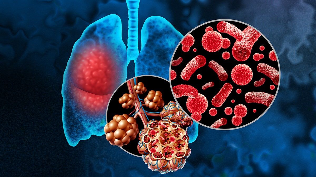 Close-up view of lungs affected by pneumonia showing inflammation