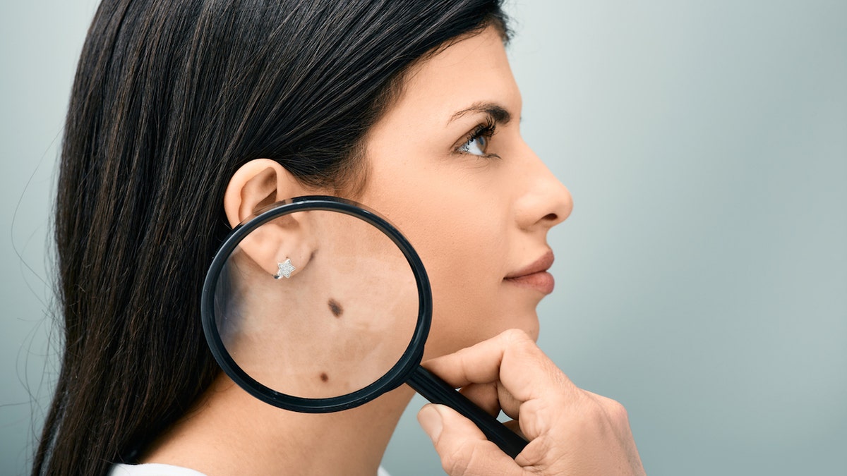 Woman holding magnifying glass showing mole and birthmark on her body