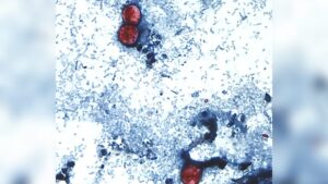 A diarrhea-causing parasite has infected more than 1,000 in the U.S. Is it in Canada?