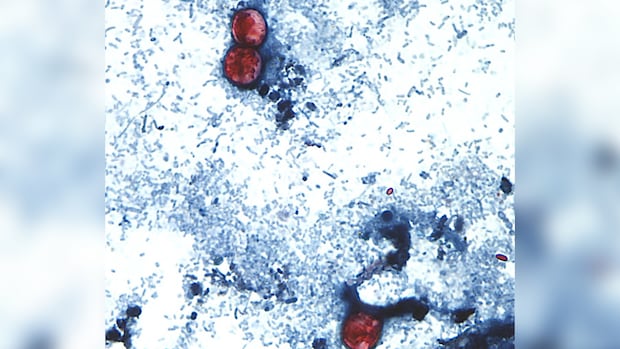 A diarrhea-causing parasite has infected more than 1,000 in the U.S. Is it in Canada?