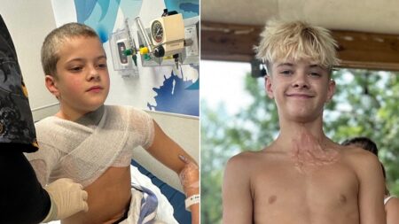 Microwaved squishy toy explodes onto boy’s face and chest amid viral trend, causing horrific burns