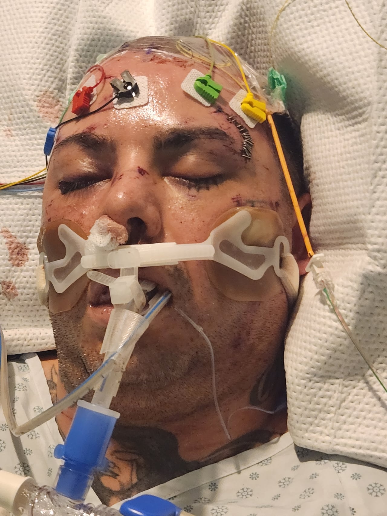 A man with a tattoo of a woman on his throat is lying unconscious in a hospital bed. He's wearing a hospital gown; there are tubes in his mouth and nose, and wires on his head. There are drops of blood on his pillow, near his right ear. His face has scrapes and dried blood. There is a large gash above his left eyebrow that has been stapled together.
