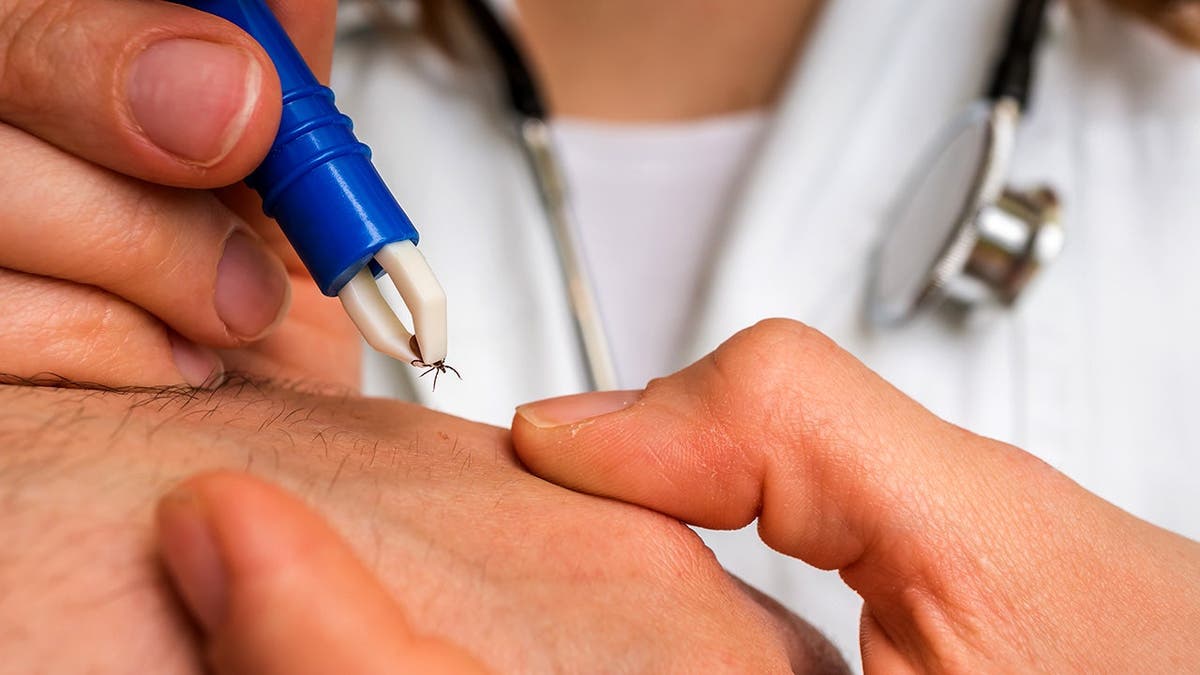 A doctor removes a tick from a person.